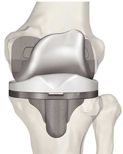 Prothèse de genou sur mesure Origin, du fabricant suisse Symbios