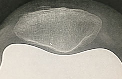 Radio post-opératoire de la rotule après prothèse Origin
