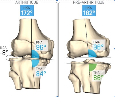 Planification de la pose d'une prothèse de genou en utilisant le logiciel KneePlan pour reproduire le genou tel qu'il était avant l'arthrose.