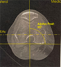Mesure de la position de la rotule par rapport au fémur, à partir du scanner