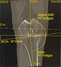 Mesure des angles entre fémur et tibia à partir du scanner