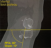 Mesure de profil de la pente tibiale