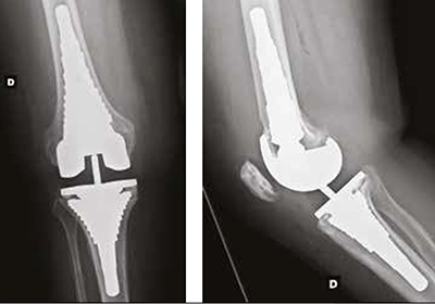 Radios de reprise de prothèse de genou avec manchons, charnière et longues tiges