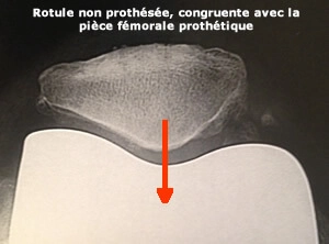 Radio d'une prothèse de genou avec une rotule non resurfacée et parfaitement centrée
