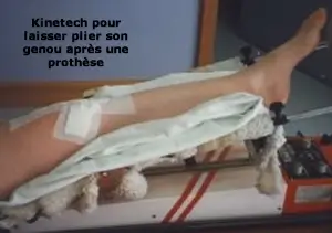 reeducation de la flexion du genou avec le kinetech