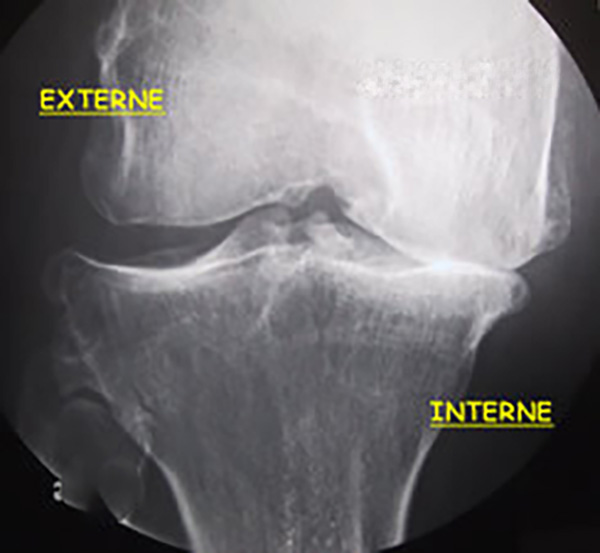 Radio d'une arthrose interne du genou droit de face