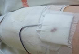 Drain de Redon sortant du pansement