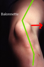 Photo d'un genou avec la rotule luxée