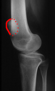 Radiographie de profil montrant une rotation de la rotule en extension