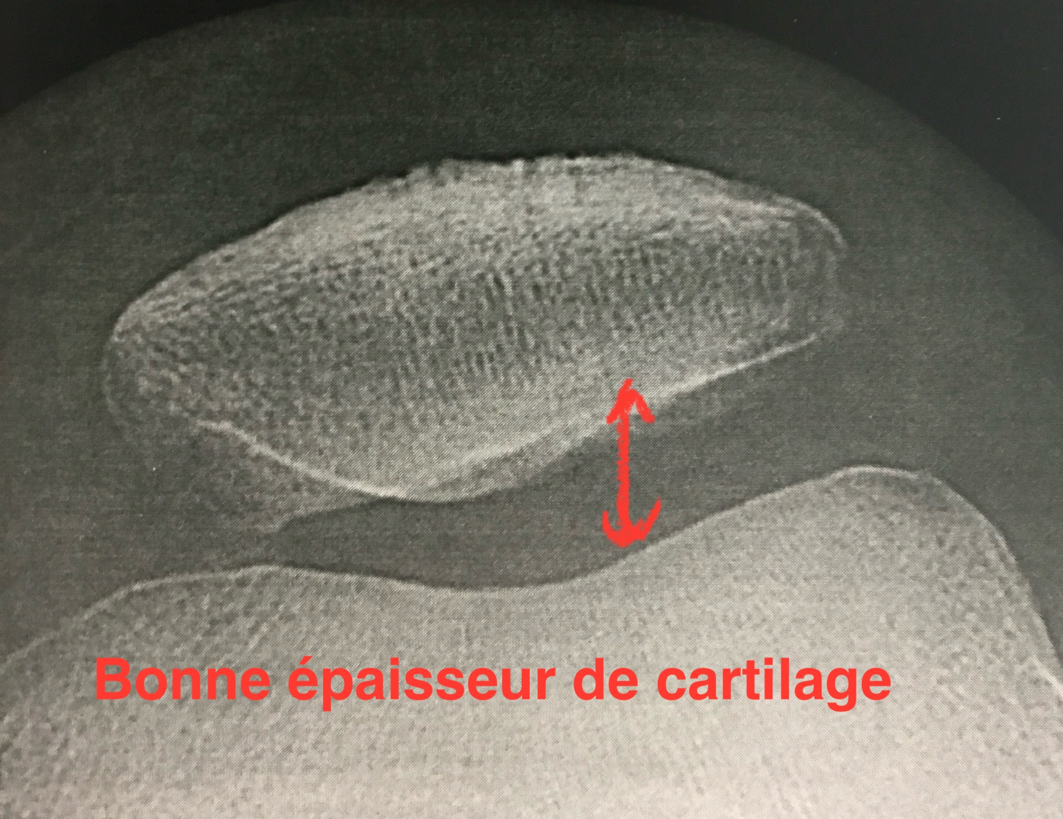 Radio : défilé fémoro-patellaire normal, sans pincement