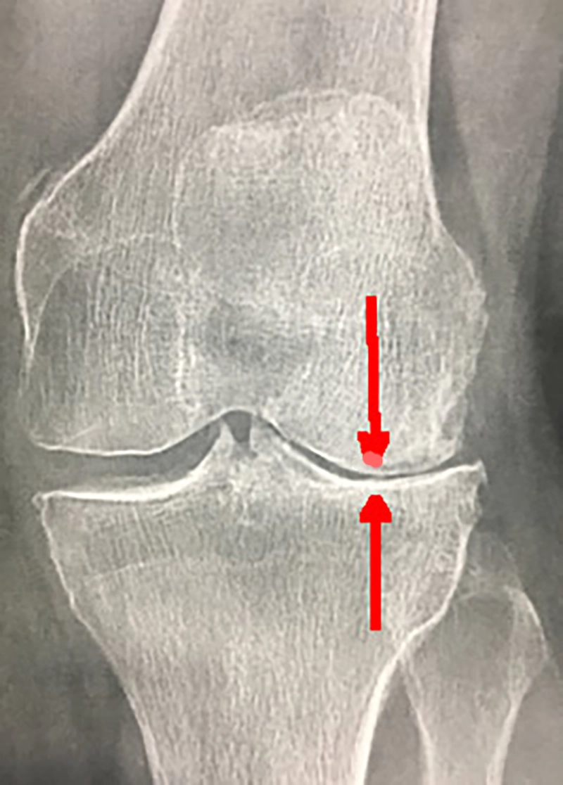 Radio de face d'une arthrose fémoro-tibiale externe du genou gauche