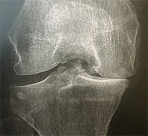 Pincement de l'interligne interne, entre fémur et tibia sur une radio debout, témoignant d'une arthrose interne du genou