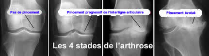 Les stades de l'arthrose du genou selon Ahlback