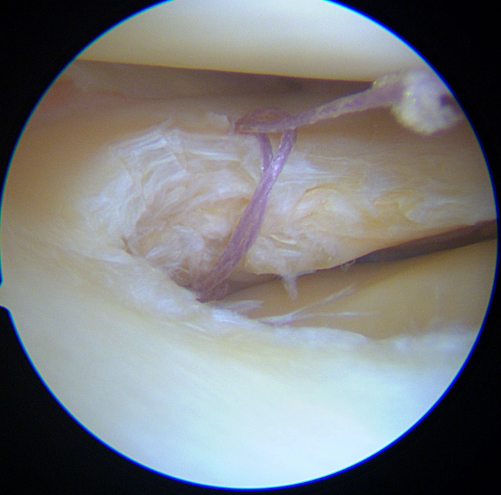 suture meniscale sous arthroscopie