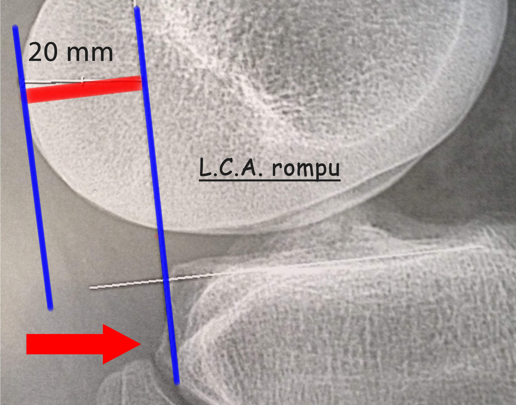 Test du télos radiologique d'une rupture du lig croisé antérieur