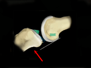rupture du ligament croisé antérieur avec tiroir antérieur