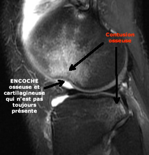 contusion osseuse typique d'une rupture du ligament croisé antérieur