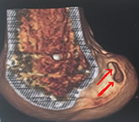 Vue de profil du fémur; les flèches montrent la zone d'insertion du ligament. Insertion fémorale du ligament croisé antérieur
