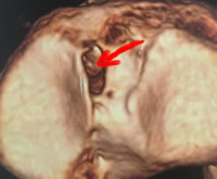 vue supérieure du tibia; la flèche montre la zone d'insertion du ligament. Insertion tibiale du ligament croisé antérieur