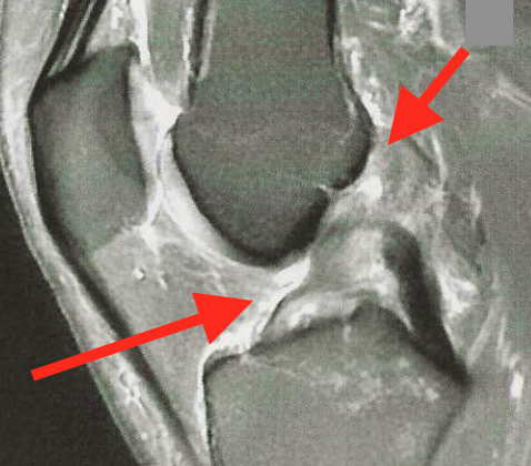 Image IRM d'une rupture du ligament croisé antérieur 