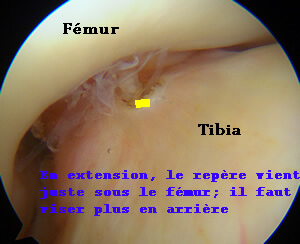 la sortie du tunnel tibial ne doit pas géner l'extension.