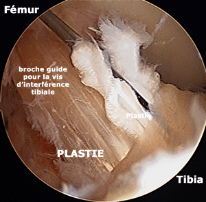 Broche dans le tunnel tibial entre l'os et la greffe