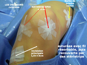 Cicatrices après opération du LCA