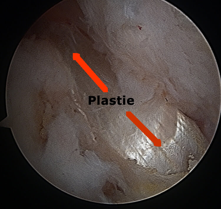 Plastie du ligament croisé antérieur.