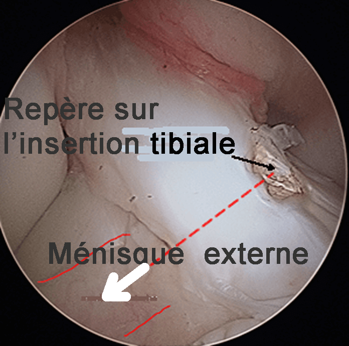 Zone  d'insertion tibiale du LCA