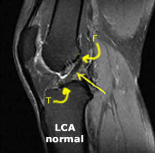 image IRM d'un ligament croisé antérieur normal