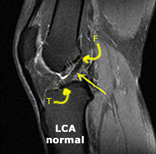 ligament croisé antérieur normal sur une IRM
