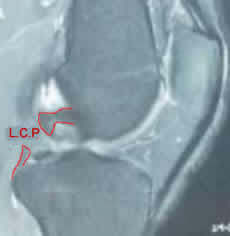 Irm d'une rupture du ligament croisé postérieur du genou