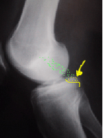 Radio de profil d'une fracture de l'épine tibiale postérieure