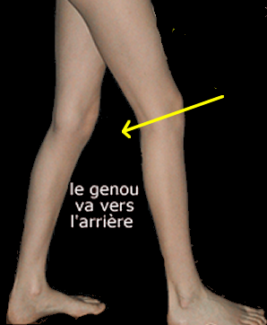 reeducation du genou : marche verrouillée