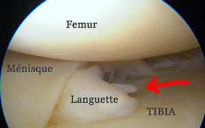 visualisation d'une languette méniscale sous arthroscopie