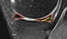 IRM avec dessin d'une lésion dégénérative de la corne postérieure