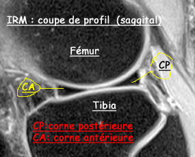 Coupe d'IRM de profil du genou