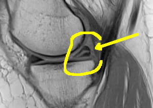 Fissure dégénérative du ménisque interne