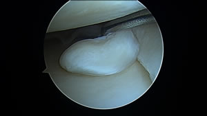 Languette méniscale du genou vue sous arthroscopie.