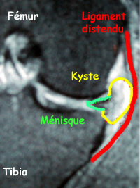 IRM d'une lésion du ménisque avec kyste méniscal