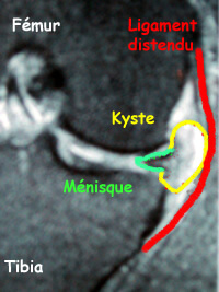 Fissure du ménisque sur l'IRM; j'ai peur que mon genou se bloque...