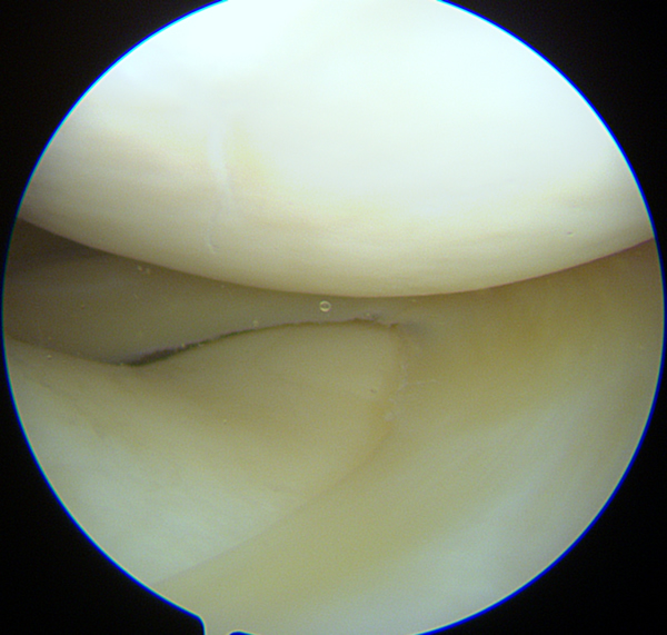 Ménisque externe normal sous arthroscopie