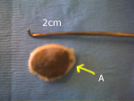 Séquestre d'une ostéochondrite