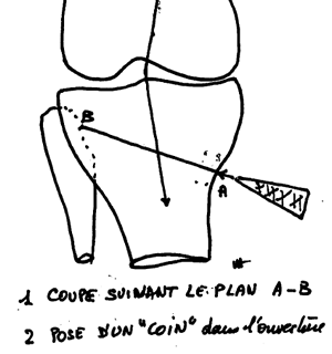 Principe d'une ostéotomie de valgisation par ouverture interne