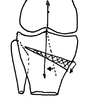 Ouverture de l'ostéotomie de valgisation