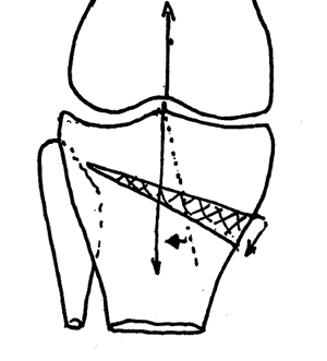 Ouverture de l'ostéotomie  de valgisation