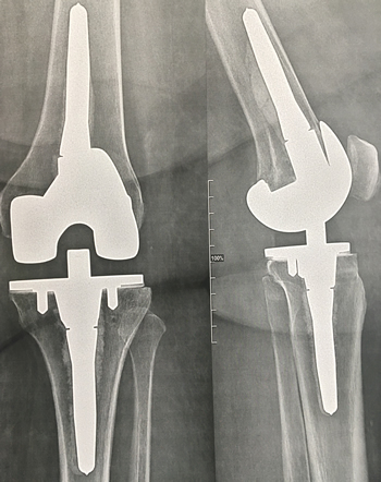 Radios d'une prothèse de reprise d'une prothèse partielle du genou