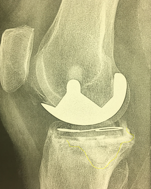 Radiographie de face, d'une prothèse unicompartimentale interne descellée.