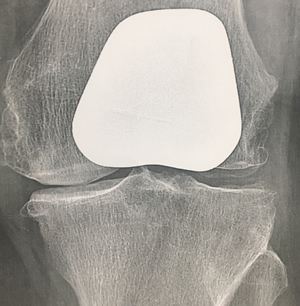 Radiographie d'une prothèse fémoro-patellaire ou rotulienne de face