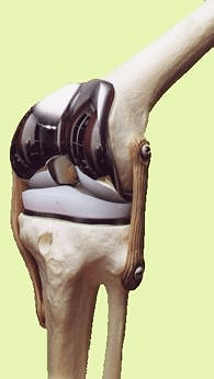 prothèse totale de genou